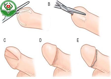 Kỹ thuật cắt bao quy đầu sẽ xác định chi phí cắt