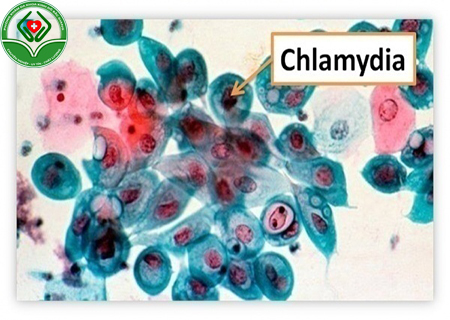 Bệnh chlamydia là gì