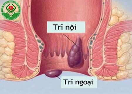 Bệnh trĩ là nguyên nhân hậu môn có vật thể lạ