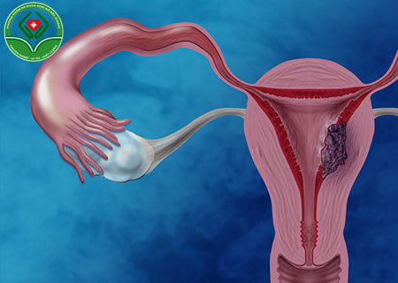 Một số kiến thức giải đáp bệnh u nang buồng trứng là gì