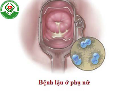 Biểu hiện bệnh lậu ở nữ giới