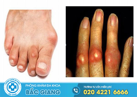 Dấu hiệu bệnh gout ở chân tay dễ nhận biết nhất
