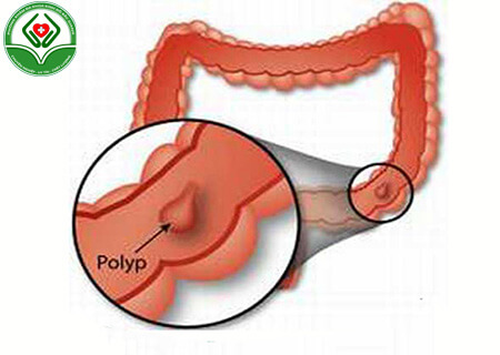 Mắc polyp hậu môn cần làm gì