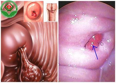 Bệnh polyp cổ tử cung là bệnh gì