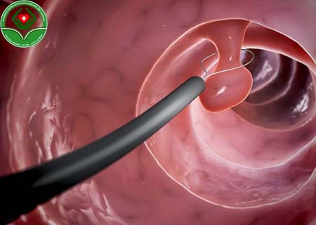 Cách cắt polyp cổ tử cung