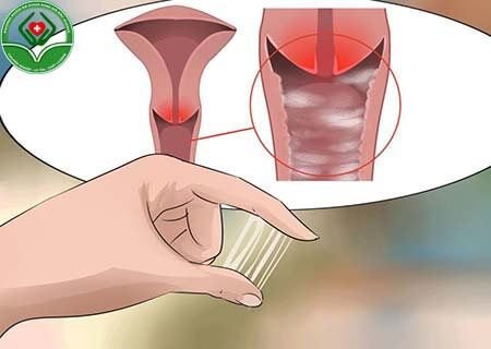 Cách điều trị viêm âm đạo dạng nặng