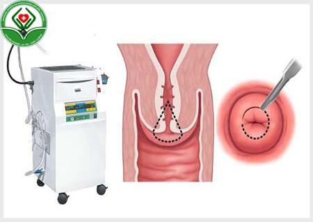 Cách điều trị viêm lộ tuyến bằng RFA