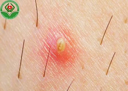 Mủ bên trong lỗ chân lông