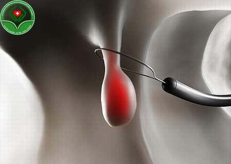 Quy trình cắt polyp cổ tử cung