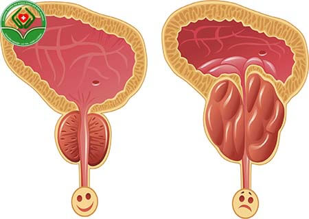 Thế nào là viêm tuyến tiền liệt