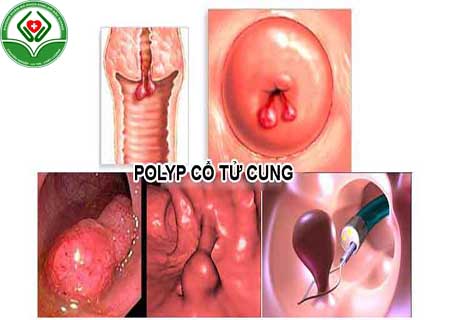 Điều trị polyp cổ tử cung sau sinh