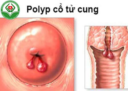 Khối polyp cổ tử cung