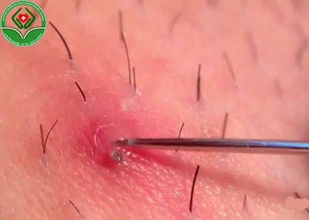 mọc mụn ở vùng lông mu mọc mụn ở vùng lông mu