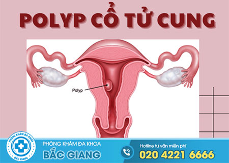 Polyp cổ tử cung có chữa được không?