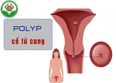 Polyp cổ tử cung