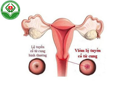 Tìm hiểu viêm lộ tuyến cổ tử cung