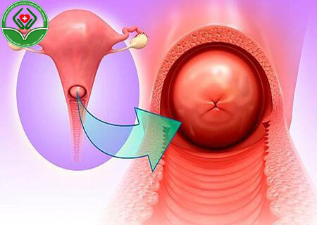 Tìm hiểu viêm lộ tuyến là gì