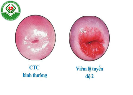 Viêm lộ tuyến độ 2