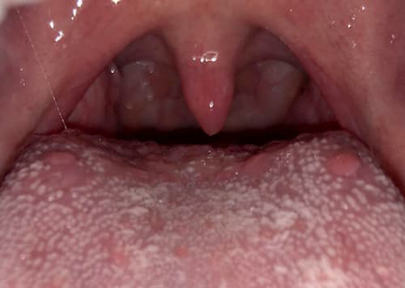 Cuống lưỡi nổi mụn đỏ là bệnh gì?