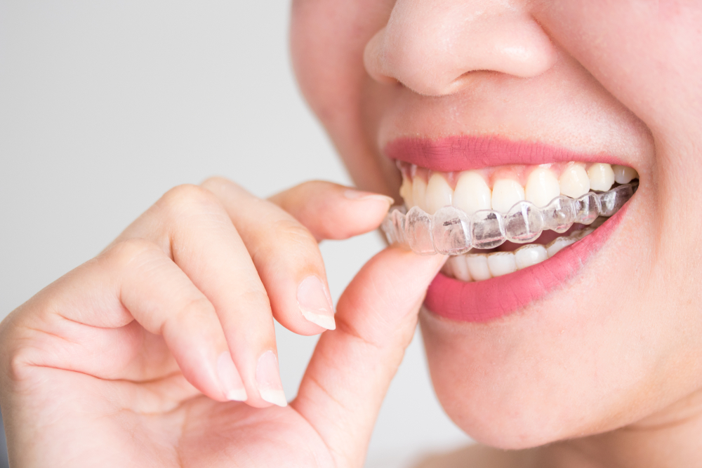Niềng răng invisalign là gì?