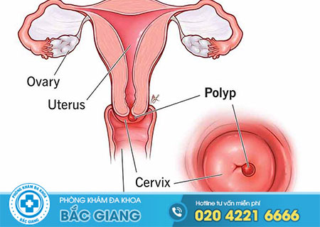 Những điều cần biết giải đáp bệnh polyp cổ tử cung là gì?