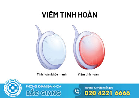 Bệnh viêm tinh hoàn là gì