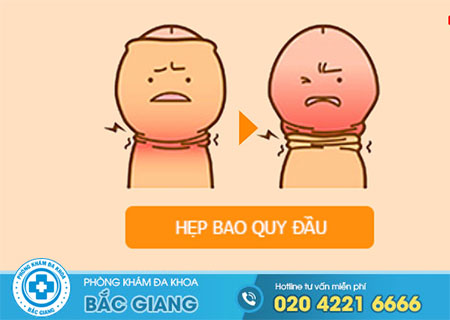 Hẹp bao quy đầu là gì?