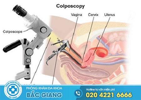 Đốt polyp cổ tử cung có đau không?