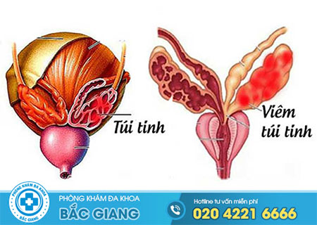 Những thông tin cần biết về bệnh viêm túi tinh