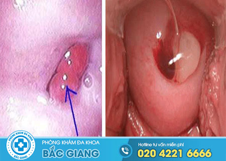 polyp-co-tu-cung-ac-tinh