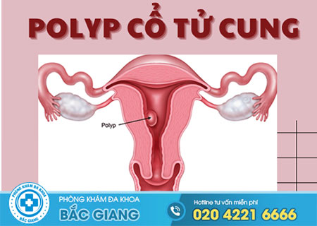 polyp-co-tu-cung-co-lay-khong