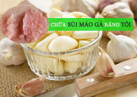 Cách chữa sùi mào gà bằng tỏi